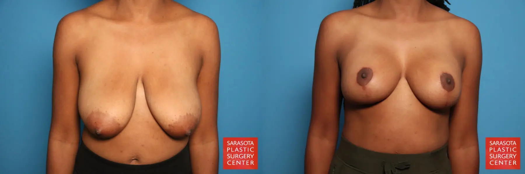 Breast Augmentation With Lift: Patient 37 - Before and After 1