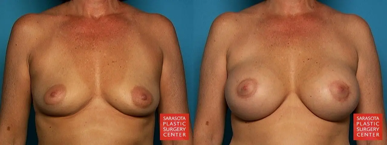 Breast Augmentation With Lift: Patient 1 - Before and After 1