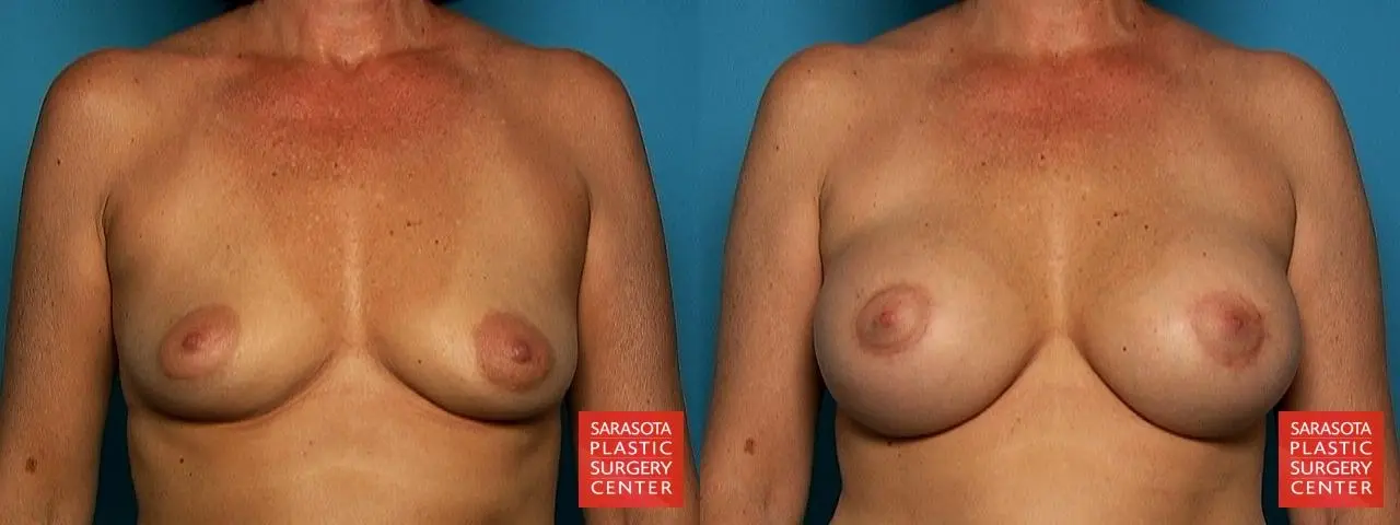 Breast Augmentation With Lift: Patient 2 - Before and After  