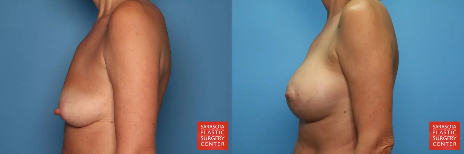 Breast Augmentation With Lift: Patient 6 - Before and After 3