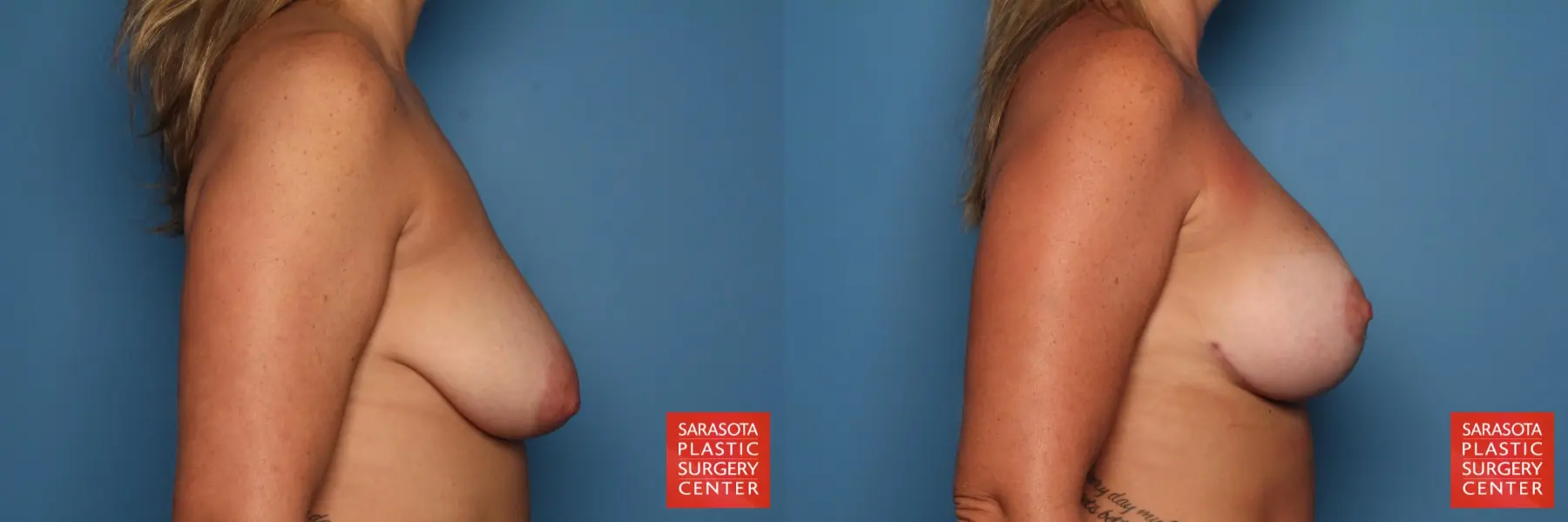 Breast Augmentation With Lift: Patient 21 - Before and After 3