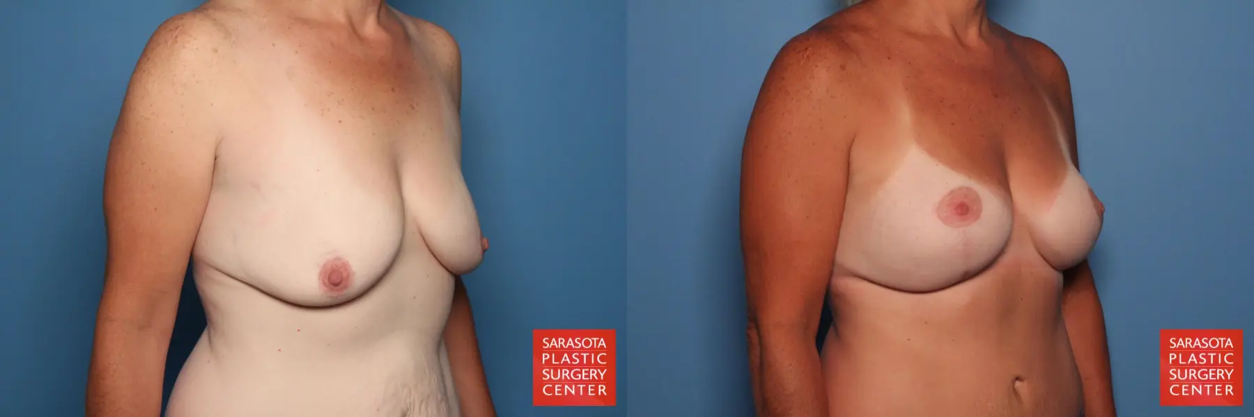 Breast Augmentation With Lift: Patient 14 - Before and After 2