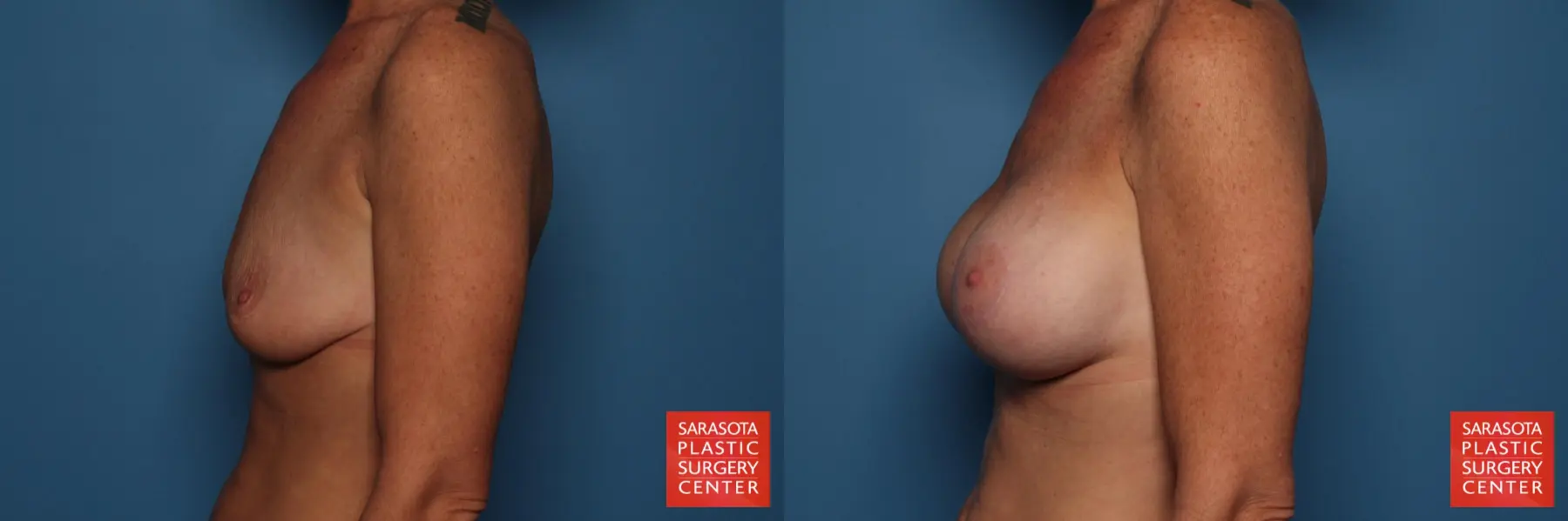 Breast Augmentation With Lift: Patient 26 - Before and After 3