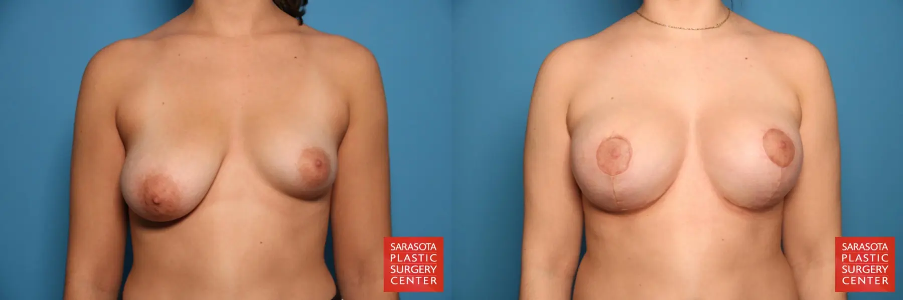 Breast Augmentation With Lift: Patient 34 - Before and After 1