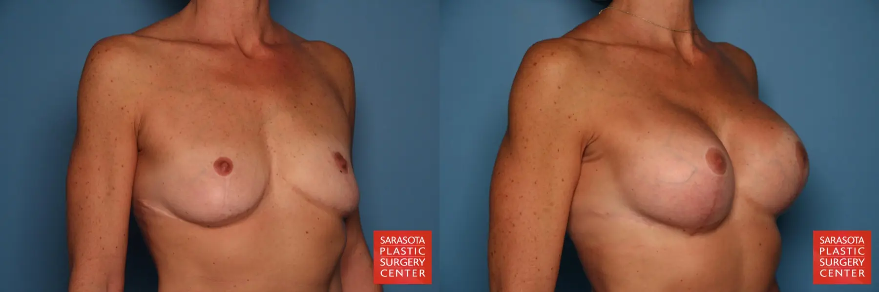 Breast Augmentation With Lift: Patient 13 - Before and After 2