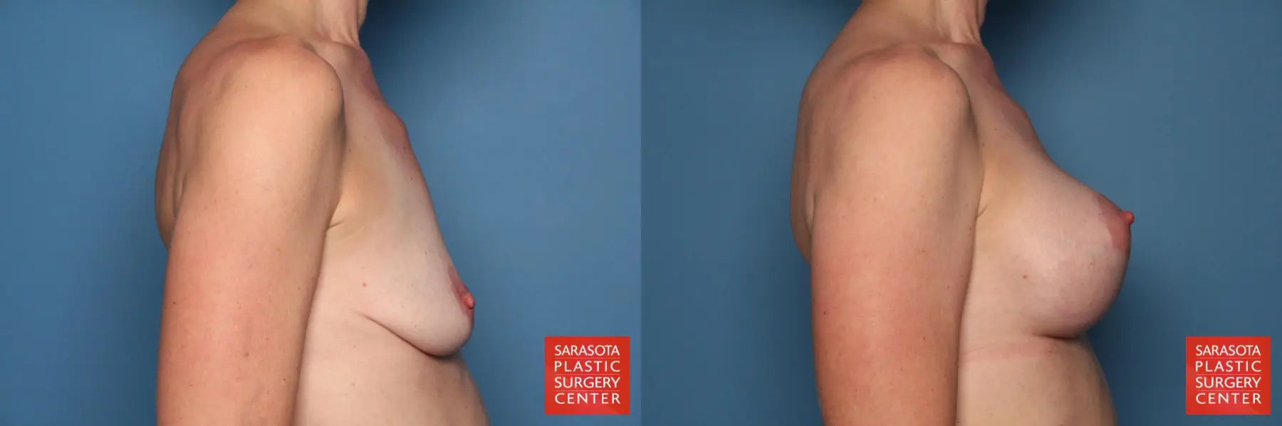 Breast Augmentation With Lift: Patient 27 - Before and After 5