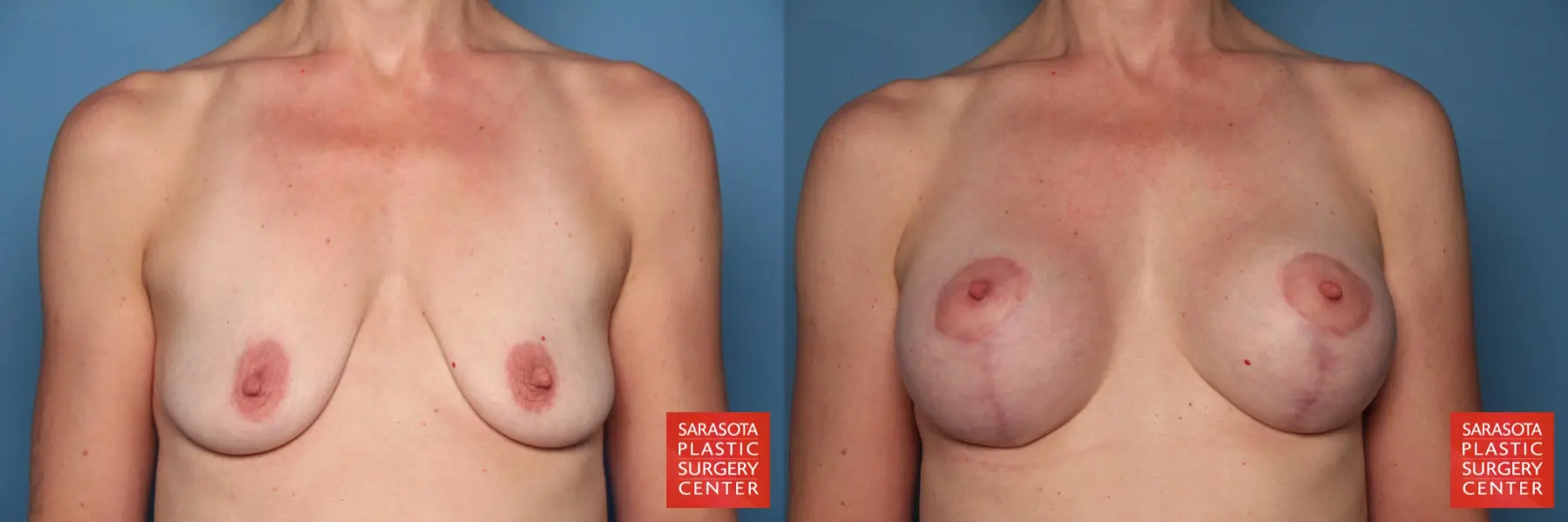 Breast Augmentation With Lift: Patient 27 - Before and After 1