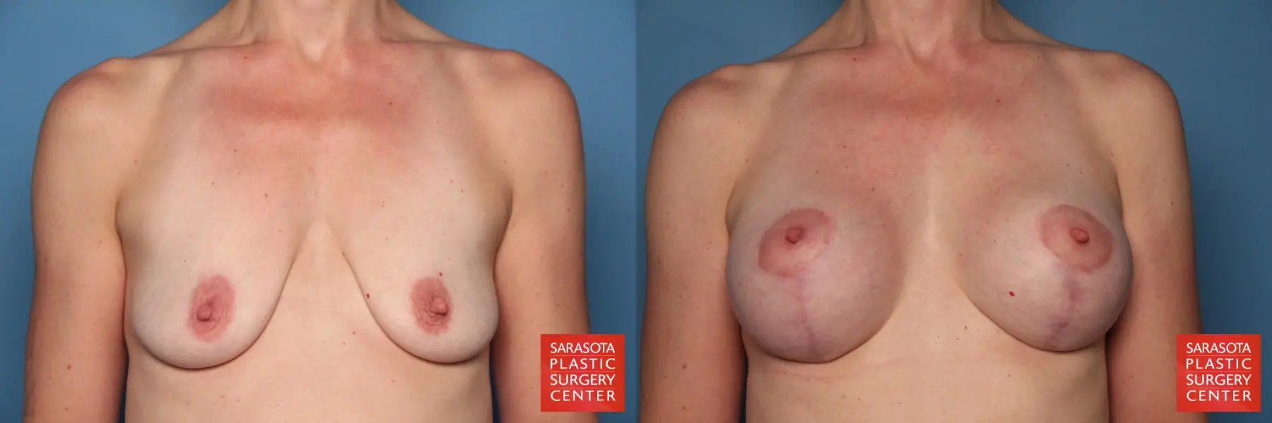 Breast Augmentation With Lift: Patient 26 - Before and After  