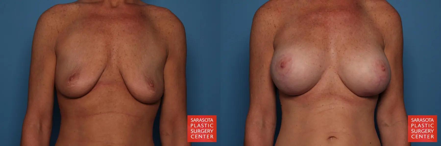 Breast Augmentation With Lift: Patient 26 - Before and After 1