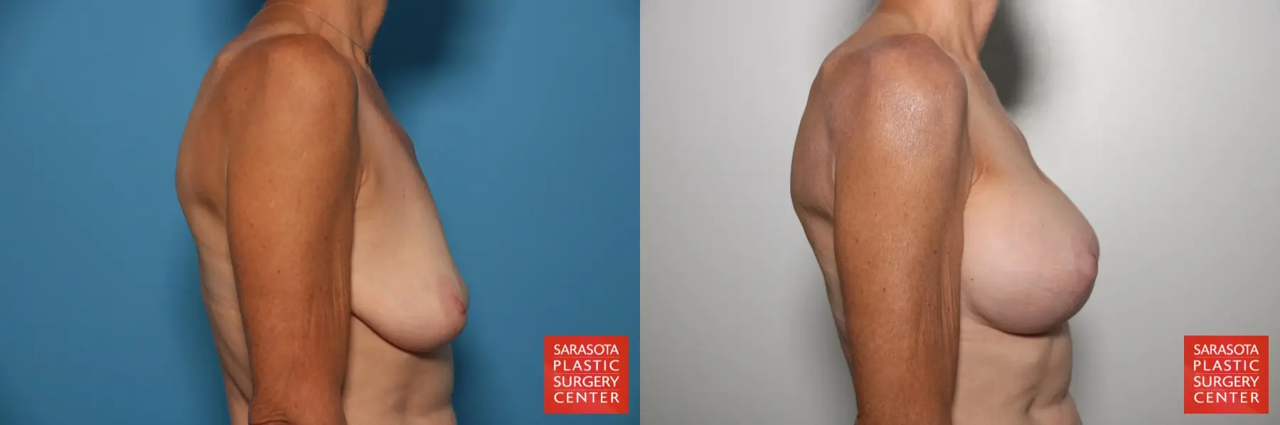Breast Augmentation With Lift: Patient 24 - Before and After 3