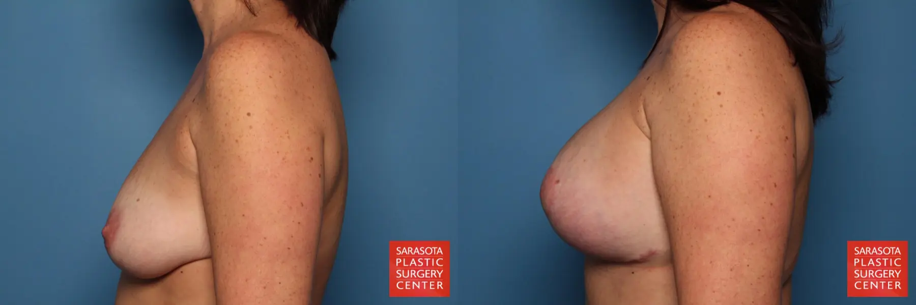 Breast Augmentation With Lift: Patient 33 - Before and After 3