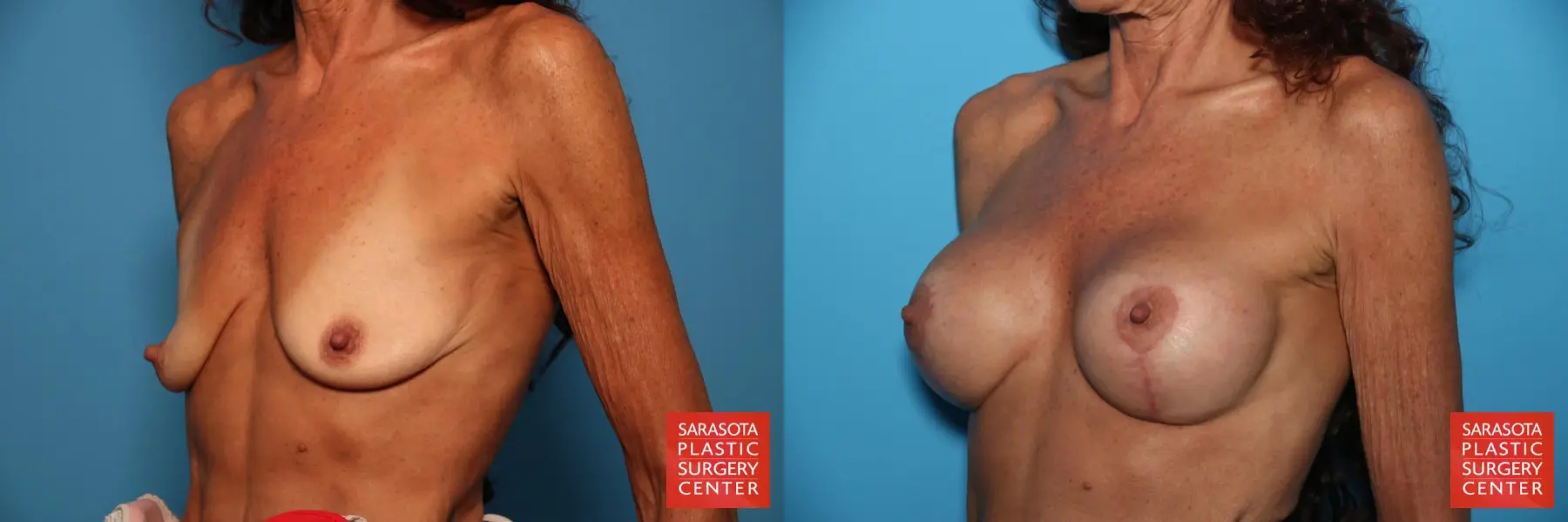 Breast Augmentation With Lift: Patient 22 - Before and After 2