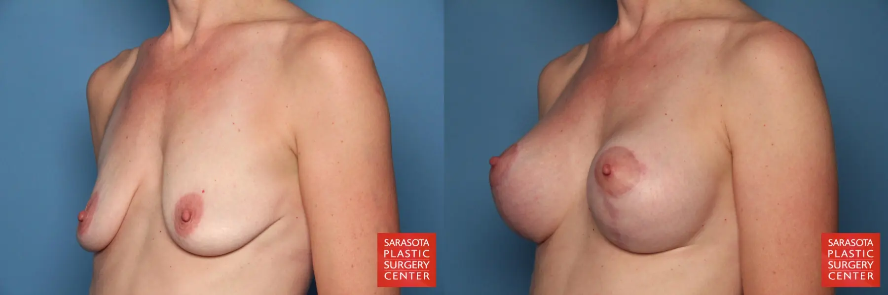 Breast Augmentation With Lift: Patient 27 - Before and After 2