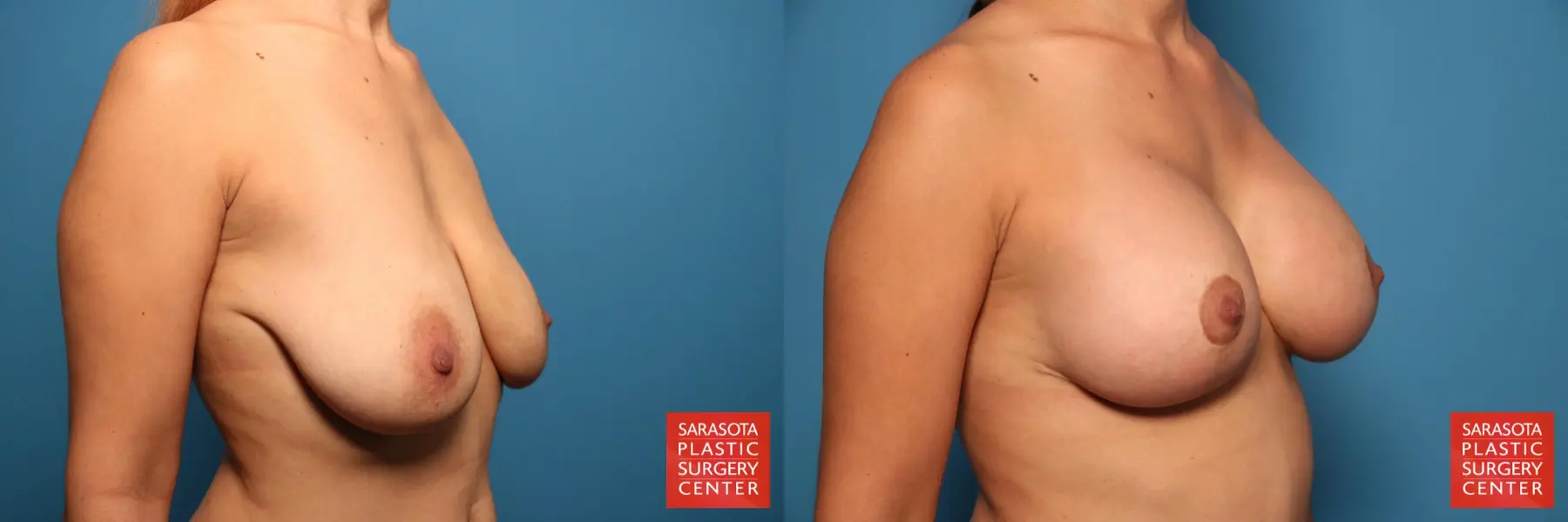 Breast Augmentation With Lift: Patient 15 - Before and After 2