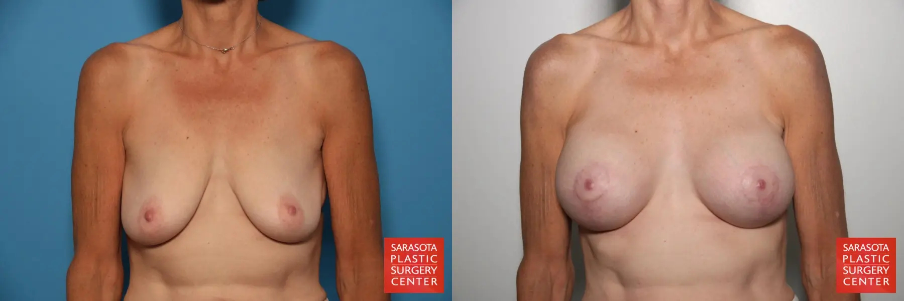 Breast Augmentation With Lift: Patient 24 - Before and After 1