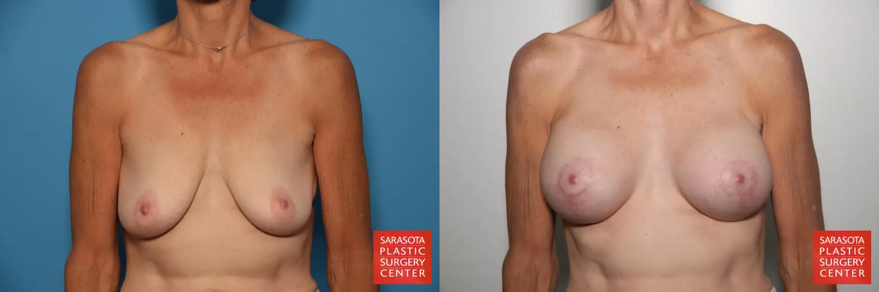 Breast Augmentation With Lift: Patient 24 - Before and After  