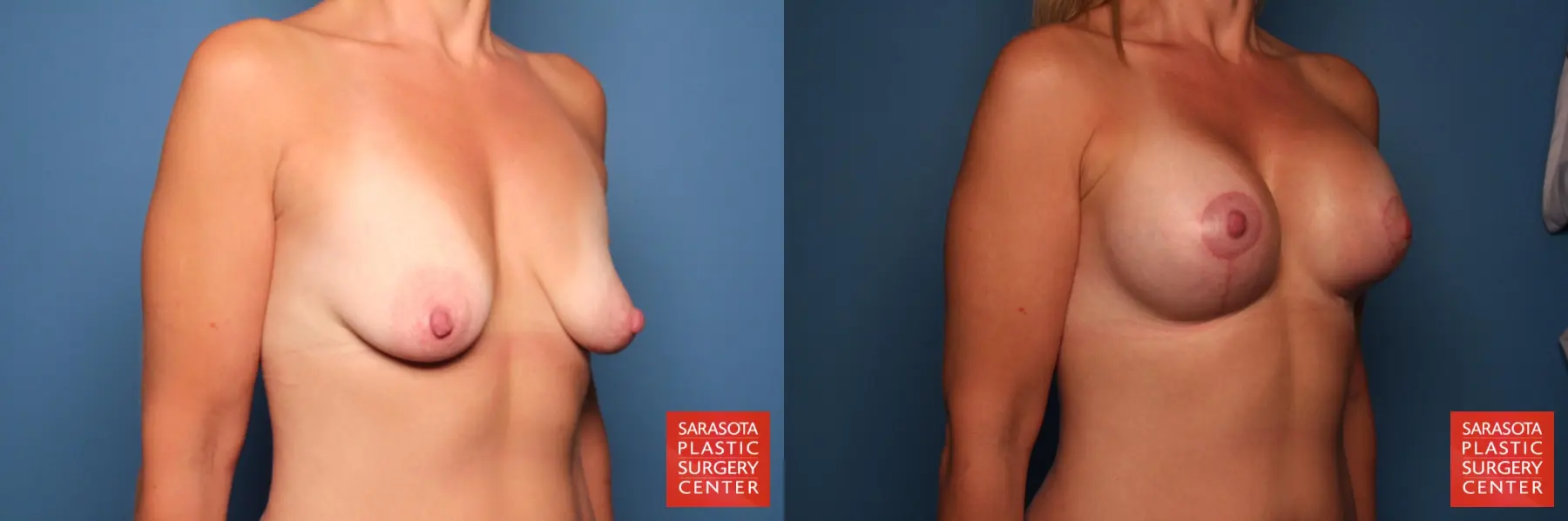 Breast Augmentation With Lift: Patient 16 - Before and After 4