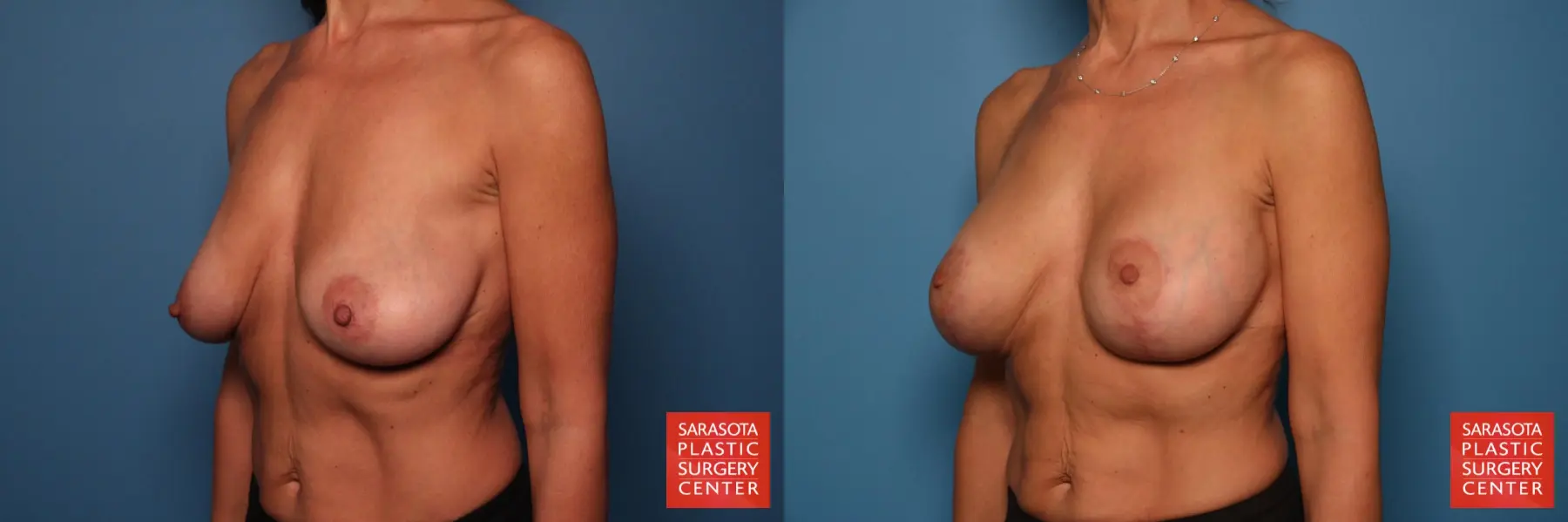 Breast Augmentation With Lift: Patient 18 - Before and After 2