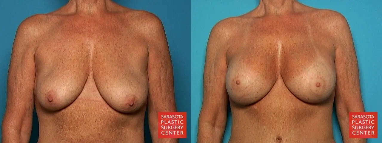 Breast Augmentation With Lift: Patient 4 - Before and After 1