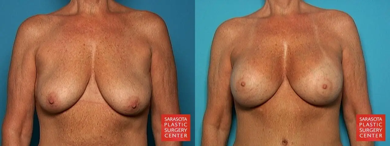 Breast Augmentation With Lift: Patient 5 - Before and After  