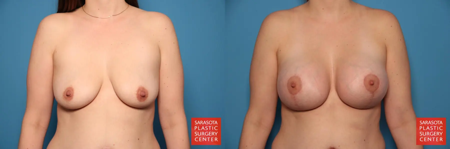 Breast Augmentation With Lift: Patient 21 - Before and After 1