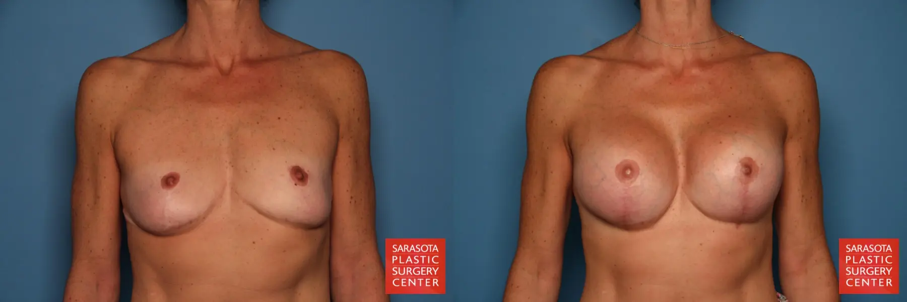 Breast Augmentation With Lift: Patient 13 - Before and After 1