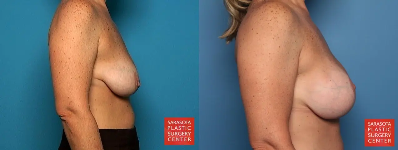 Breast Augmentation With Lift: Patient 6 - Before and After 5