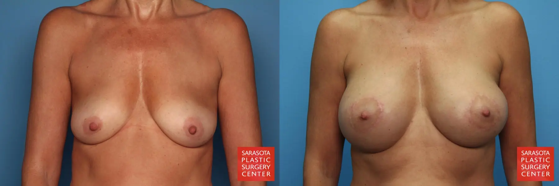Breast Augmentation With Lift: Patient 5 - Before and After 1