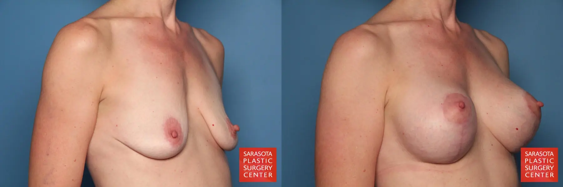 Breast Augmentation With Lift: Patient 27 - Before and After 4