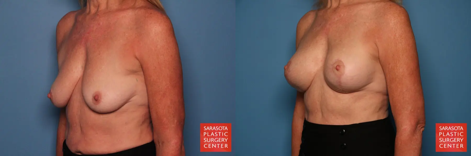Breast Augmentation With Lift: Patient 7 - Before and After 2