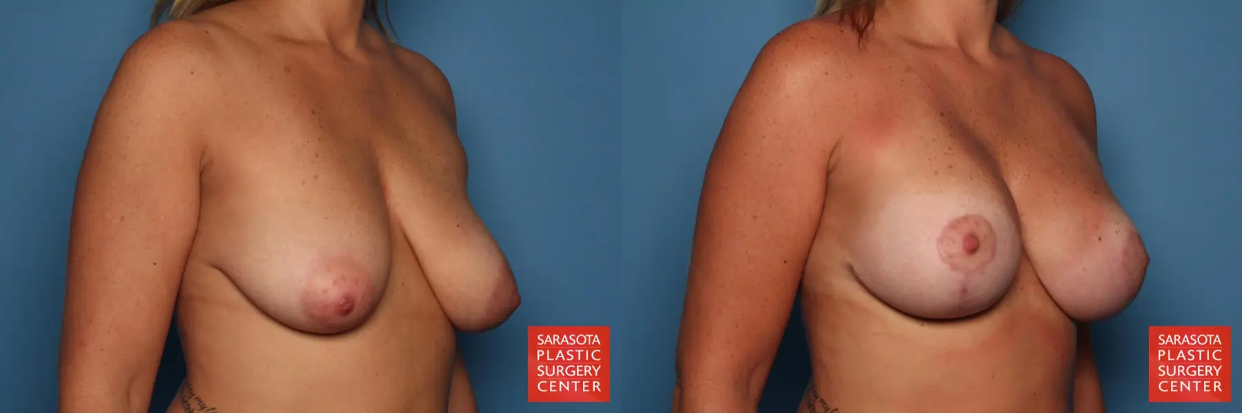 Breast Augmentation With Lift: Patient 21 - Before and After 2