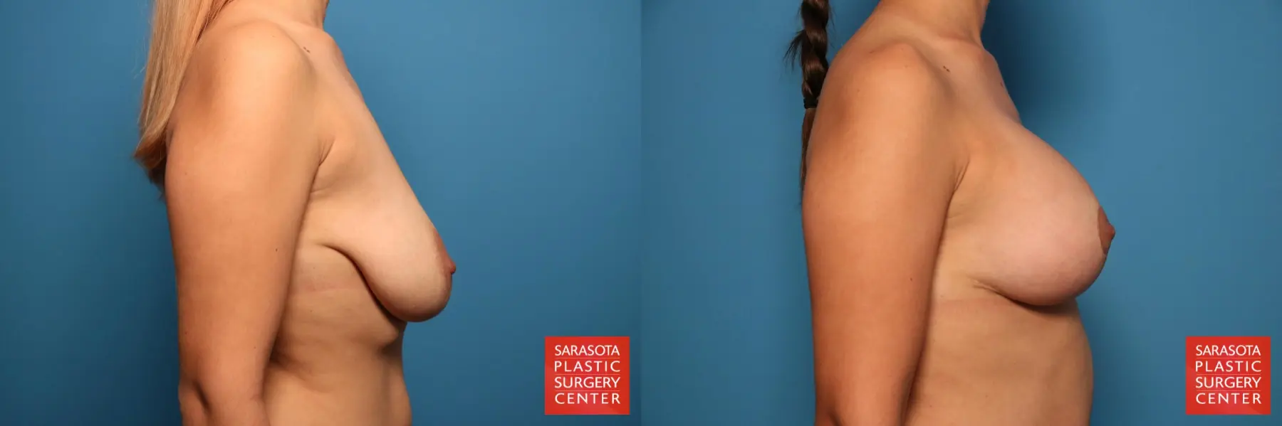 Breast Augmentation With Lift: Patient 15 - Before and After 3