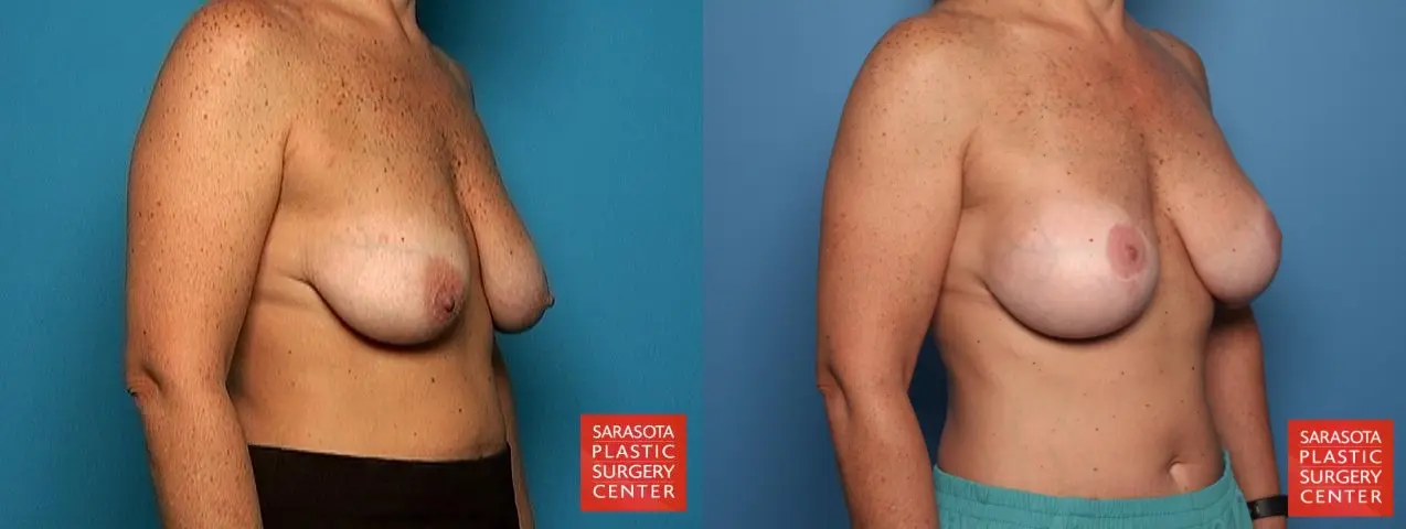 Breast Augmentation With Lift: Patient 6 - Before and After 4