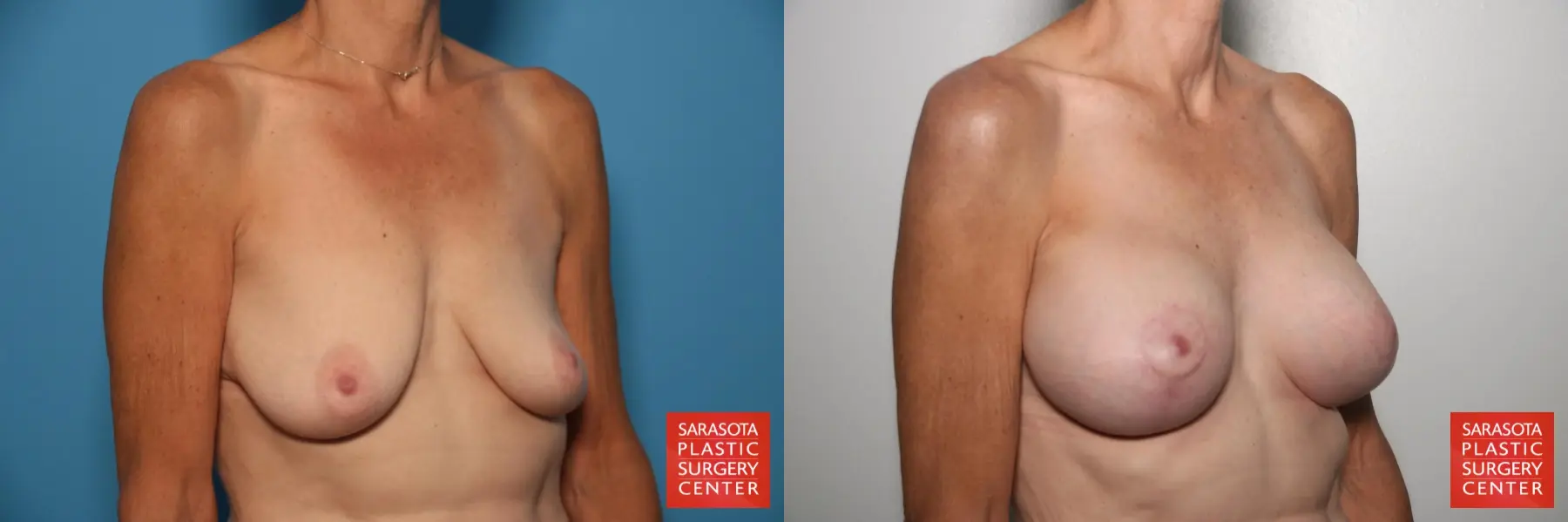 Breast Augmentation With Lift: Patient 25 - Before and After 2