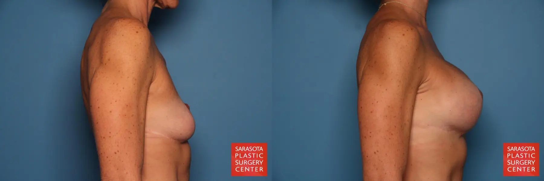Breast Augmentation With Lift: Patient 13 - Before and After 3