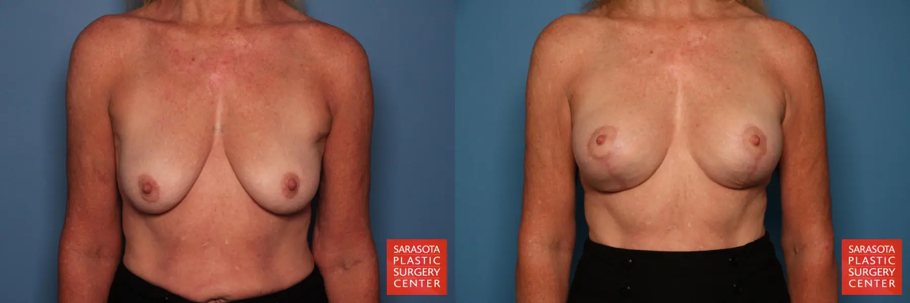 Breast Augmentation With Lift: Patient 7 - Before and After 1