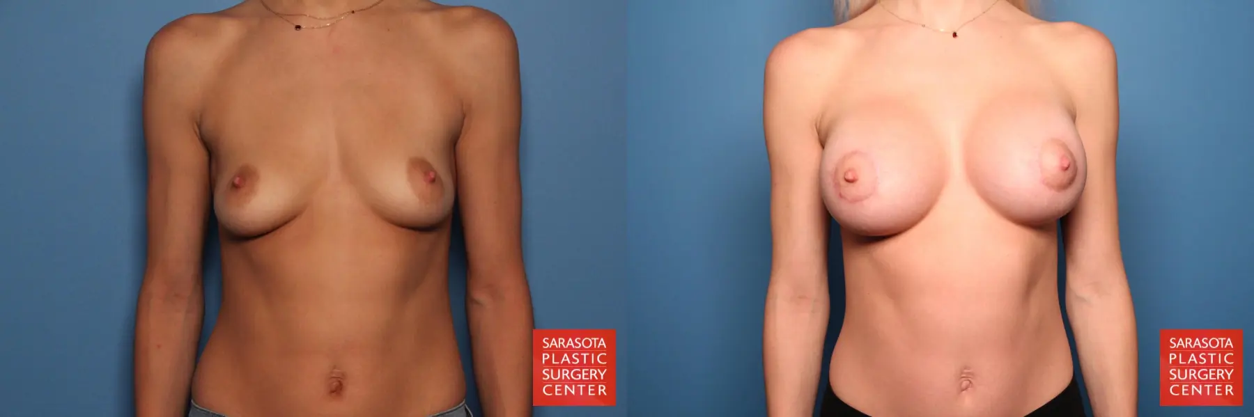 Breast Augmentation With Lift: Patient 10 - Before and After 1