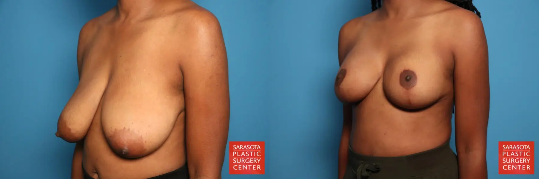 Breast Augmentation With Lift: Patient 37 - Before and After 2