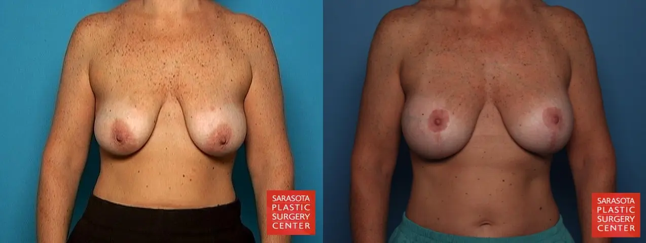 Breast Augmentation With Lift: Patient 6 - Before and After 1