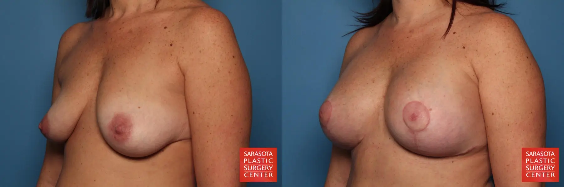 Breast Augmentation With Lift: Patient 33 - Before and After 2