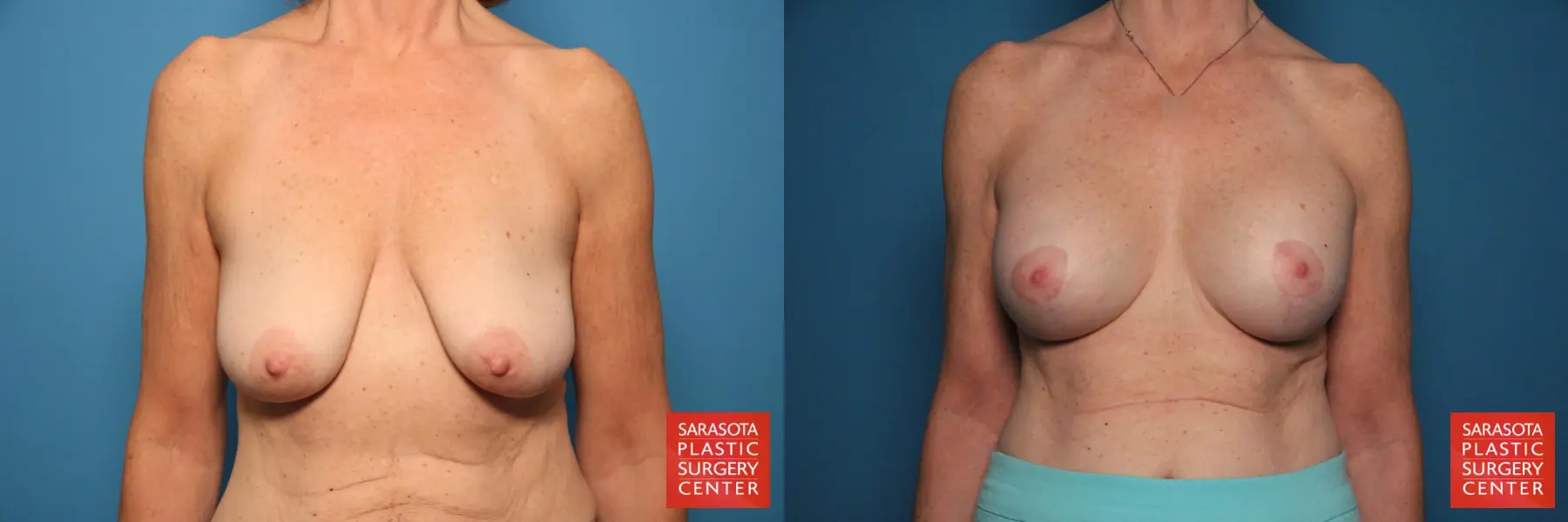Breast Augmentation With Mesh : Patient 1 - Before and After  