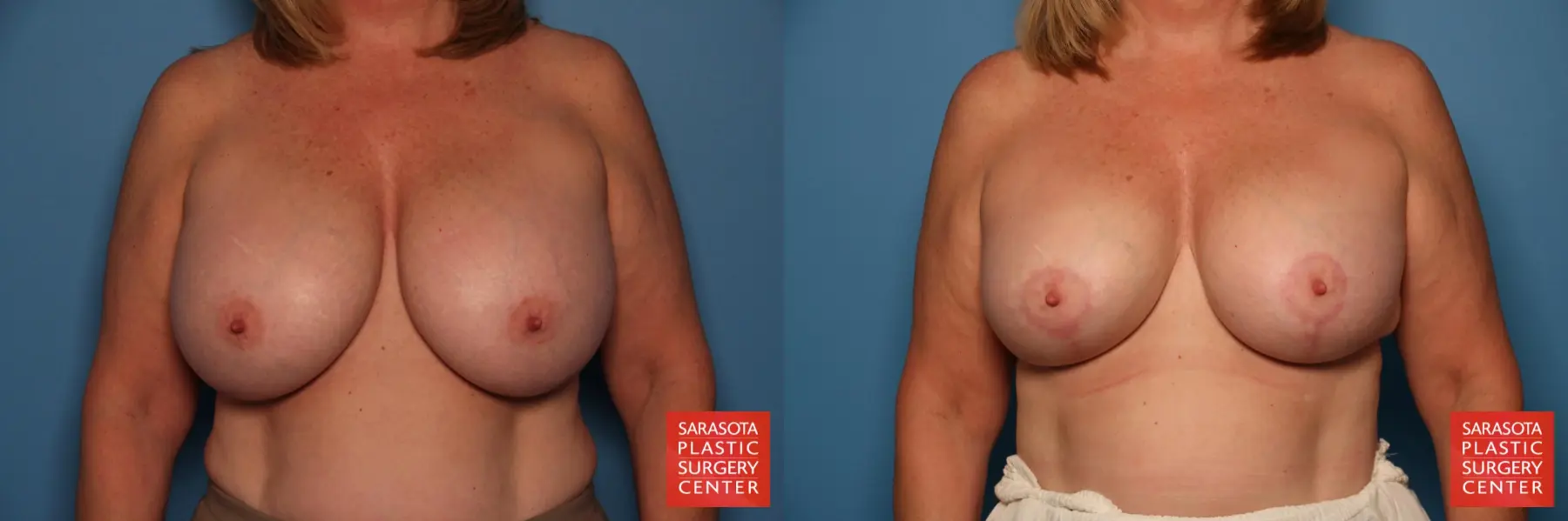 Breast Augmentation With Mesh : Patient 6 - Before and After  