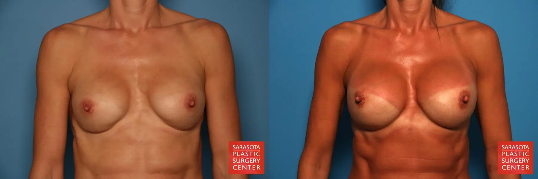 Breast Augmentation With Mesh : Patient 10 - Before and After  