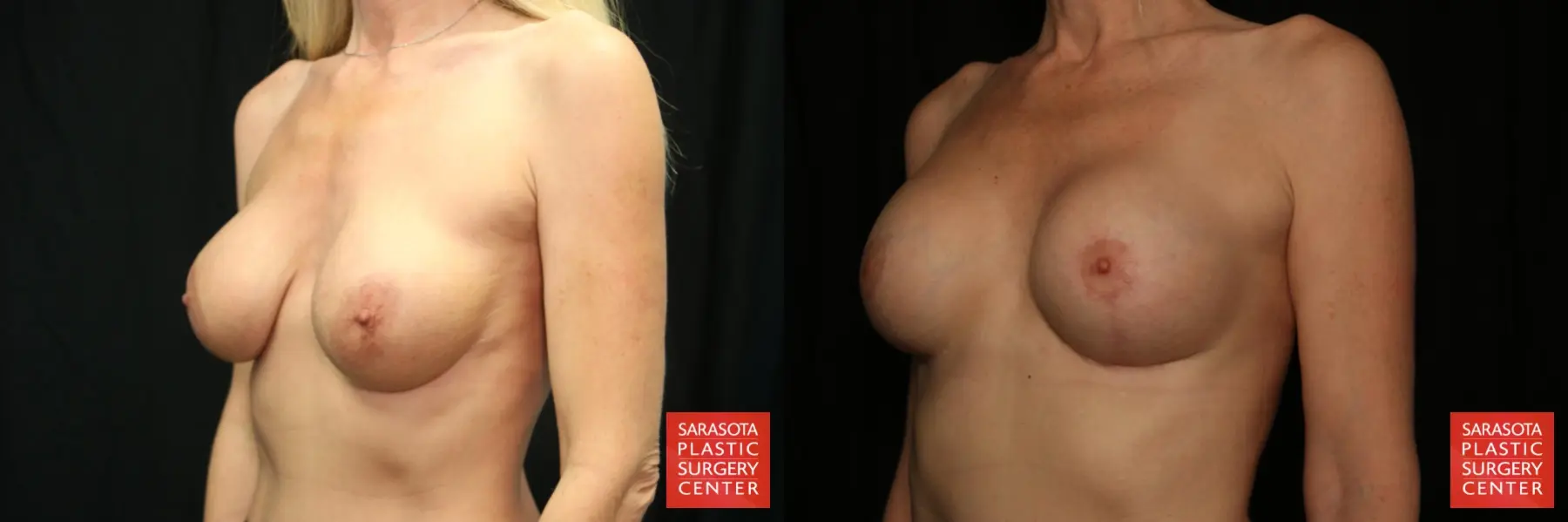 Breast Augmentation With Mesh : Patient 18 - Before and After 2