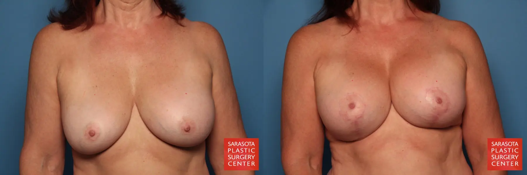 Breast Augmentation With Mesh : Patient 4 - Before and After  