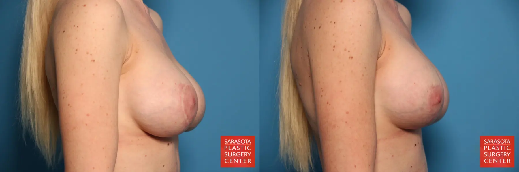 Breast Augmentation With Mesh : Patient 14 - Before and After 3