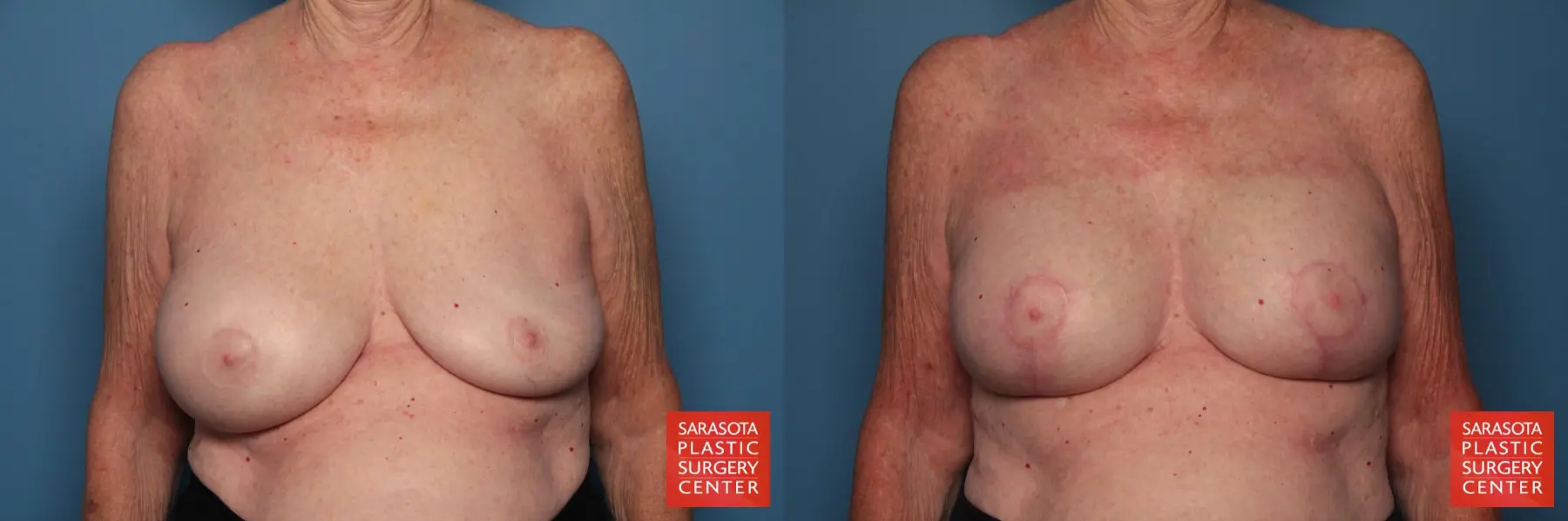Breast Augmentation With Mesh : Patient 1 - Before and After  