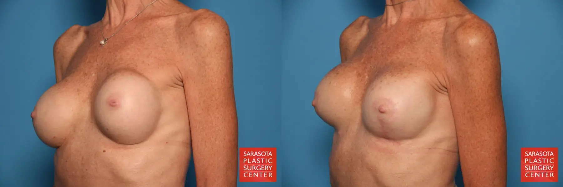 Breast Augmentation With Mesh : Patient 15 - Before and After 2
