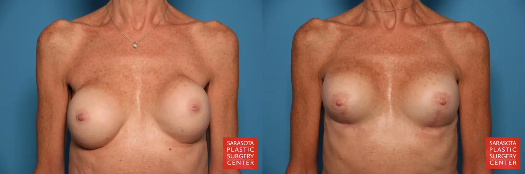 Breast Augmentation With Mesh : Patient 14 - Before and After  