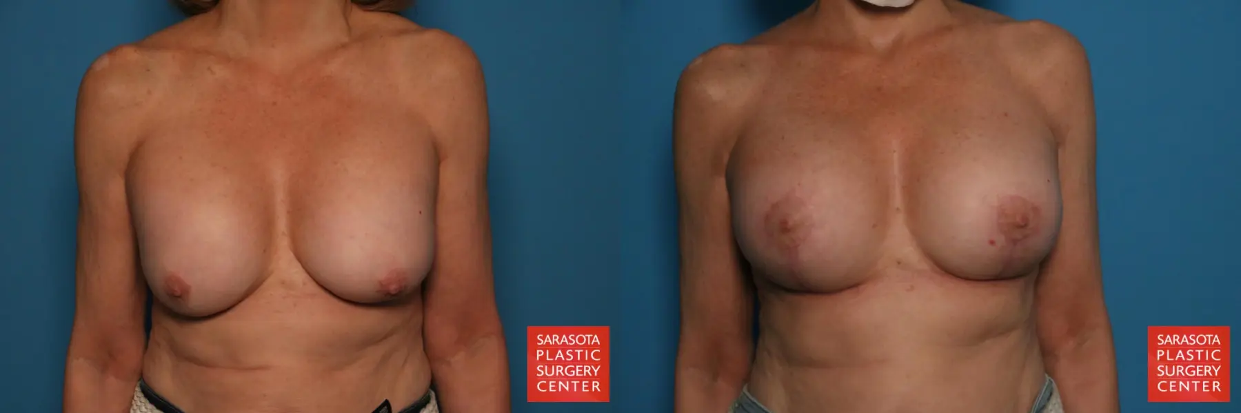Breast Augmentation With Mesh : Patient 16 - Before and After  